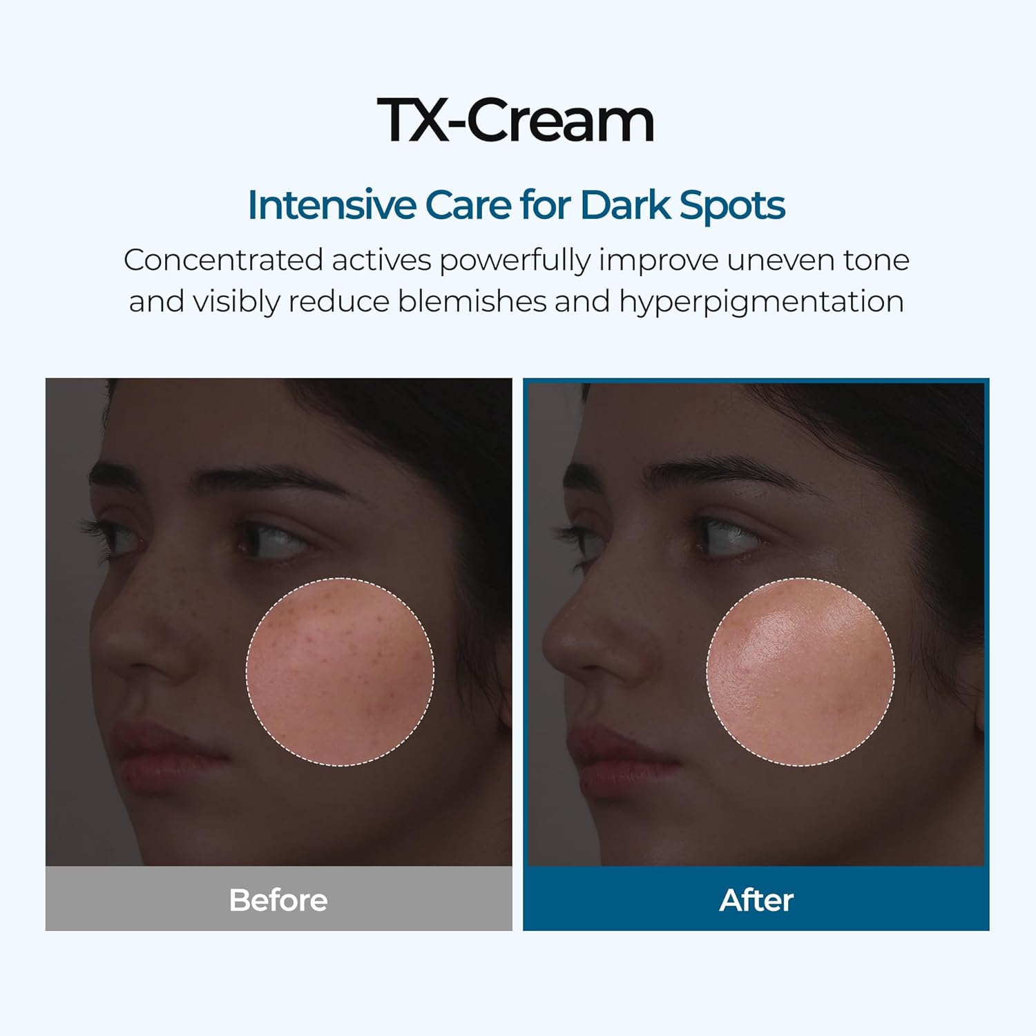TX Tranexamic Acid CREAM | Skin freckle Cream, Blemishes, Anti-pigmetation korean skin care | Korean Cosmetics | 1.7 fl oz (50 ml)